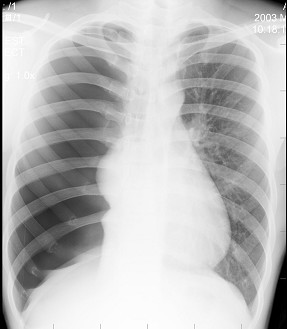 a.正常胸片 b.右侧肺气肿 c.纵隔肿瘤 d.右侧气胸 e.右侧肺栓塞