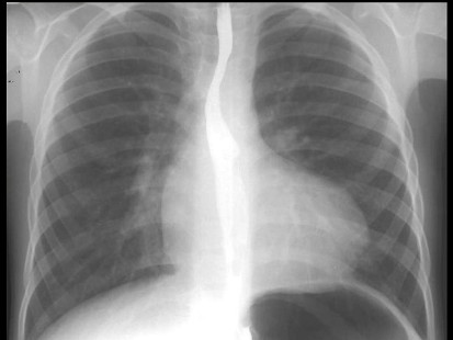 如图,x线检查表现为肺动脉段凹陷,可能为下列哪一种先天性心脏病的