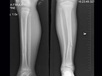患者女8岁因外伤后致右胫骨骨折下列描述正确的是