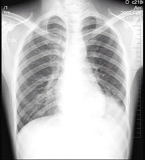 左侧胸膜肥厚 c.左下肺炎症 d.左侧胸腔积液 e.左下支气管扩张