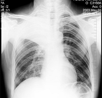 a右上肺不张 b胸膜肥厚 c包裹性积液 d炎症 e支气管扩 