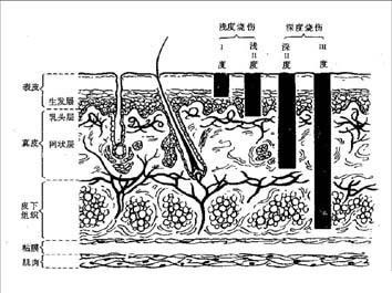 下图为烧伤深度三度四分法简图,下列叙述哪项不正确