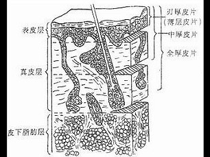 下图为皮片结构图,下列哪种皮肤移植后耐磨性差,挛缩最大