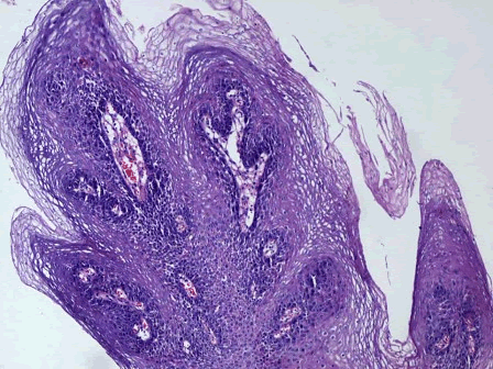 病理学试题库  a.皮肤乳头状瘤 b.皮肤乳头状癌 c.