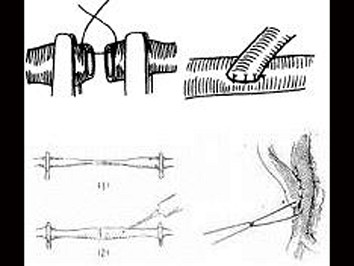 显微血管缝合吻合的方法有(附图)