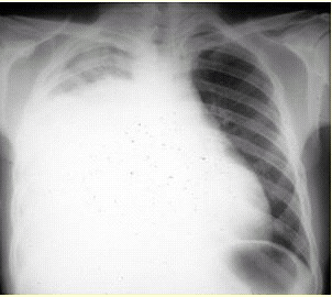 渗出性胸腔积液 c.低蛋白血症所致胸腔积液 d.结核性胸腔积液 e.恶