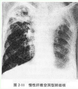 慢性纤维空洞型肺结核